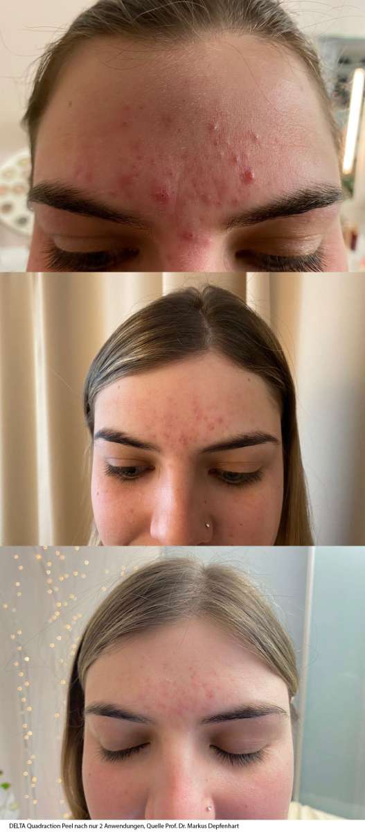 DELTA Quadration Peeling 3 sessions /Behandlungen